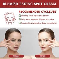 Whitening Freckle Cream,Dark Spot Remover for Face,Freckle Removal Cream,Acne Scar Removal Treatment Crea/m,Skin Lightening Cre/am for Dark Skin,Dark Spot Corrector Cr/eam,Spot C/ream for Women & Men