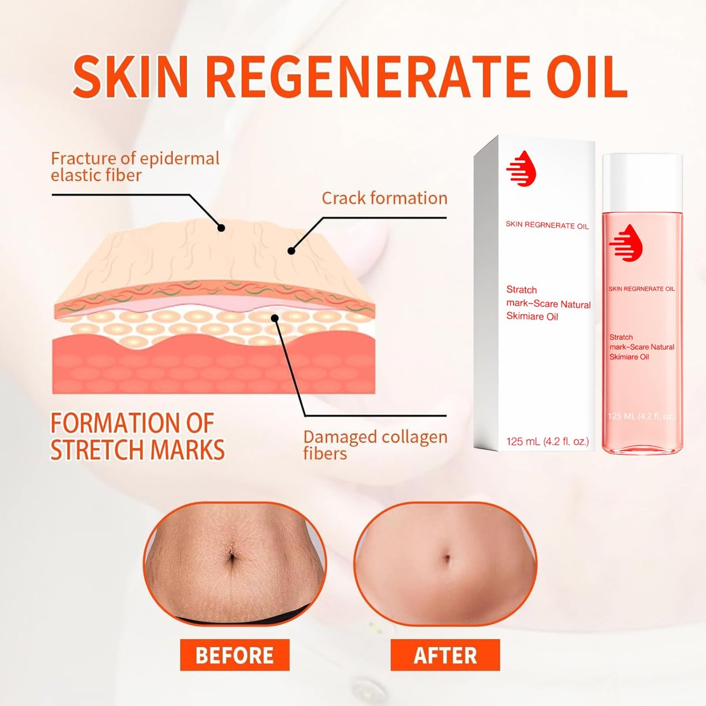 EliiSkinn Stretch-Marks, Scar Treatment Oil - Helps Reduce The Appearance Of Stretch Marks & Scars -Non-greasy Moisturizer Lotion- Improves Appearance of Stretch Marks, Scars, and Uneven Skin Tone - 125ml