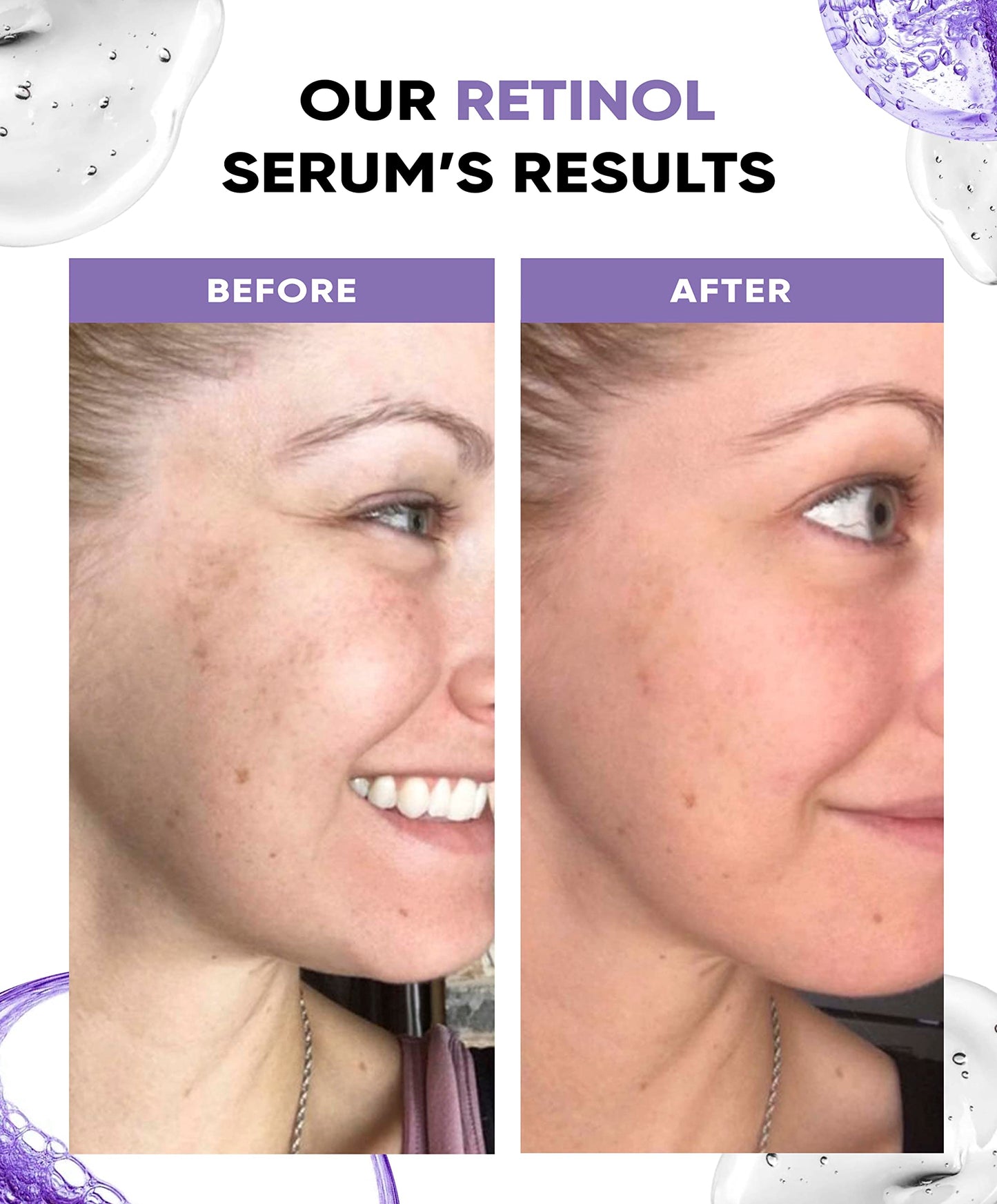 Perfect Look London Retinol Serum for face with Hyaluronic Acid, Advanced Anti Aging and Wrinkle High Strength Formula with Vitamin A/Retinoid Facelift Specialist for Reducing Wrinkles & Acne 30ml