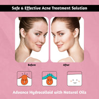 adam & eesa® Acne Patches – (Pack of 108) Dots for Hydrocolloid Spot Treatment - Face & Body Vegan Cruelty Free Skin Care Stickers, Fast-Acting Pimple Patches, Instant Blackhead Removal (8mm & 12mm)