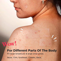 EveBeaty 240 Pcs Large Hydrocolloid Acne Patches with Tea Tree Oil, 4 Sizes & Shapes for Face, Large Pimple Patches, Chin, Body & Nose | Fleck Spot Treatment Stickers