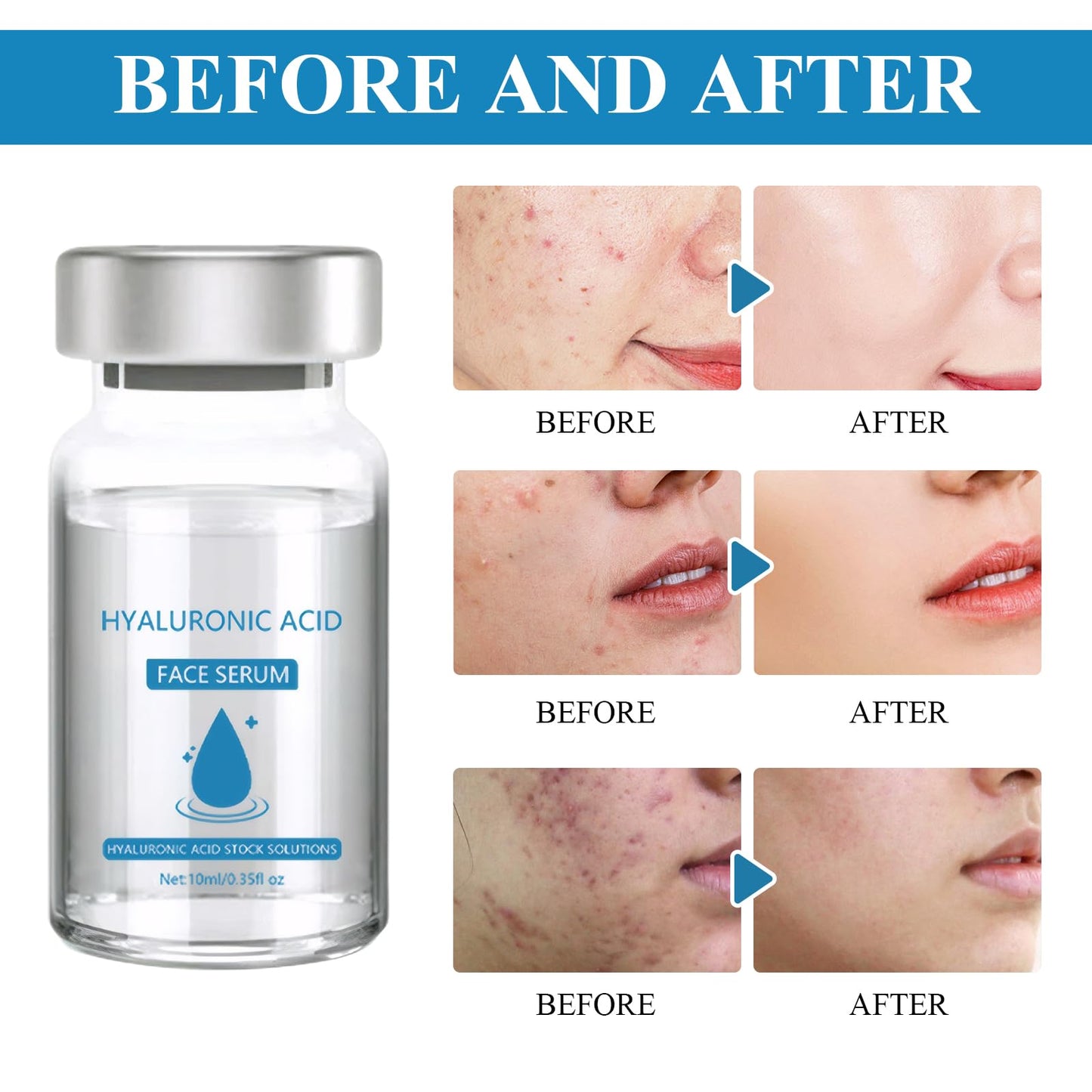 MADGININE Micro Infusion Facial System,Micro Infusion Kit,Beauty Micro Infusion Micro Infusion System Hyaluronic Acid Serum for Face Suitable for All Skin Types (3*Serum+Roller)