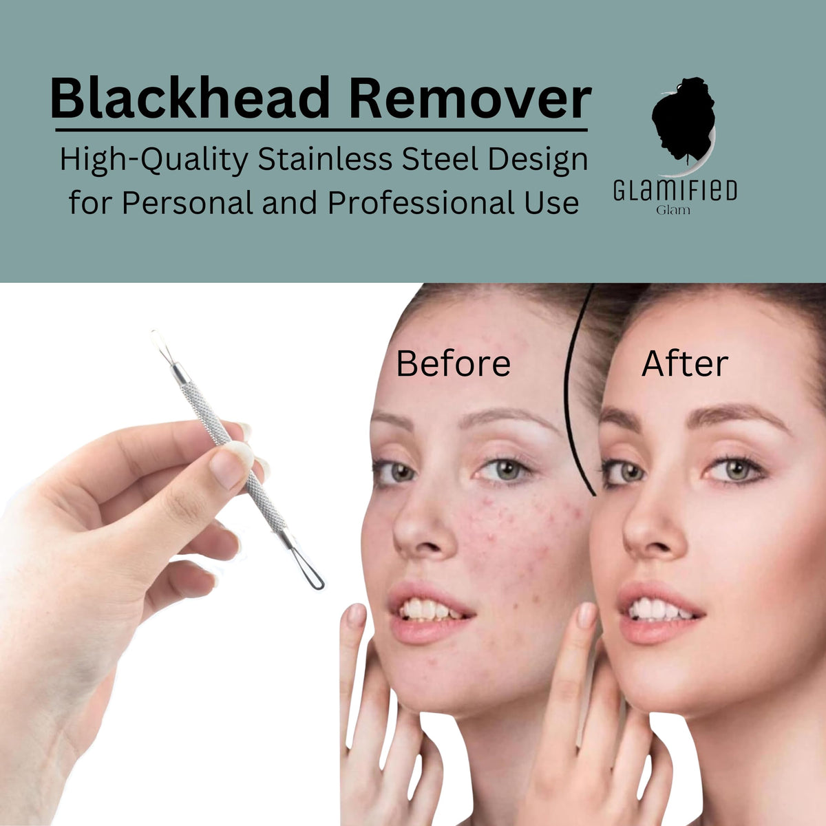 Glamified , glam Glamified Blackhead Remover Professional Skincare Spot Treatment Blackhead Remover Tool for Blemish Comedone Whiteheads Pimple Popper with Double Sided Soft Touch and Anti-Slip Design