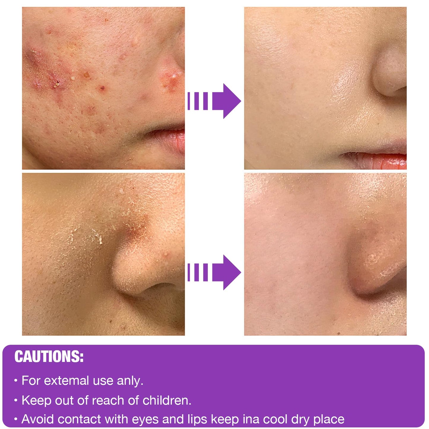 XdealCozyxc 2 PCS The Ordinary Azelaic Acid Serum, Azelaic Acid Cream Brightening Face Skin Care Pigmentation Treatment for All Skin Types