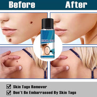 YXtecd 2pcs Skin Tag Removal Kit, 30ML