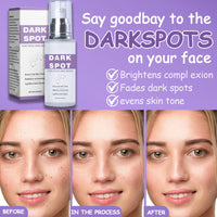 Trendyfave 2Pcs Dark Spot Remover for Face & Body, Dark Spot Corrector Cream with Niacinamide & Hyaluronic Acid, Age Spot Remover, Melasma Cream for Sun Spots & Hyperpigmentation, Brightening, Even Skin Tone