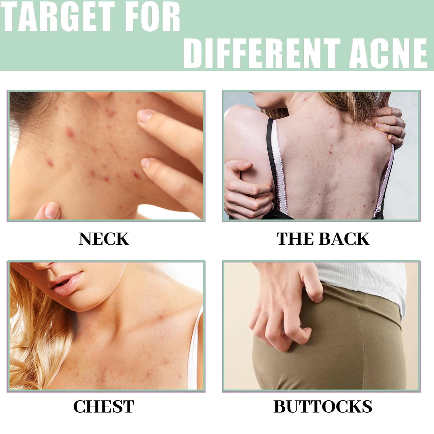 DMQ Acne Treatment Spary,Back Acne Treatment Serum,Body Moisturiser For Acne,Body Moisturiser For Dry Skin,Acne Moisturiser,Reduce Back Acne & Body Acne,Smoothing Moisturiser For Acne Prone Skin-120ml