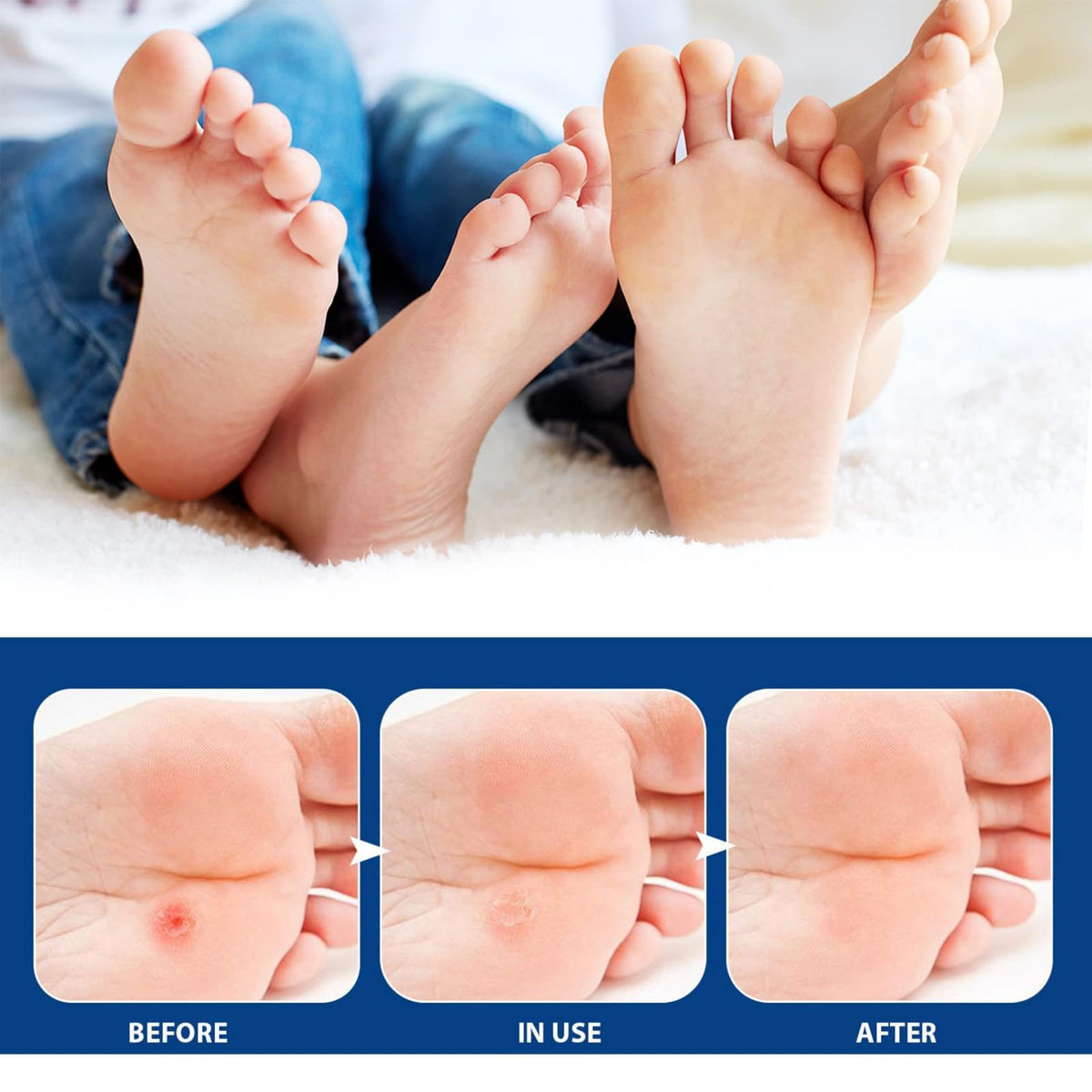 Ruojiar 24Pcs Verruca Treatment Corn Plasters,Wart Remover,Corn Remover for Feet and Hand,Gentle and Safe Verruca Plasters,Wart Removal Patches,Foot Care for Women and Men,Pain Relief,Gentle and Skin-friendly