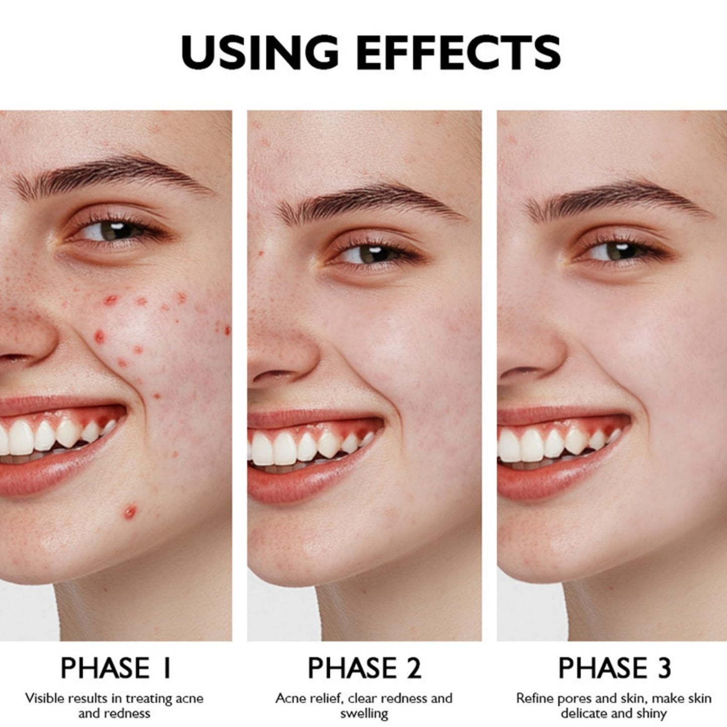 Siyinzu Acid Face Cream,10% Acid Gel For Facial and Skin Care,Ac/id 10% Acne Tratment Ge/l,Anti Acne G/el for Spot Prone Sk/in,Brightening Face S/kin Care Treatment,Dark Spot Serum Cream for Face