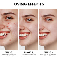 Siyinzu Acid Face Cream,10% Acid Gel For Facial and Skin Care,Ac/id 10% Acne Tratment Ge/l,Anti Acne G/el for Spot Prone Sk/in,Brightening Face S/kin Care Treatment,Dark Spot Serum Cream for Face