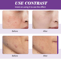 Azelaic Acid Cream,Azelaic Acid Face Cream,Azelaic Acid Serum,Azelaic Acid 12% Facial Serum,Facial Serum Cream,Niacinamide & Vitamin C Face Cream,For All Skin Types (20g)