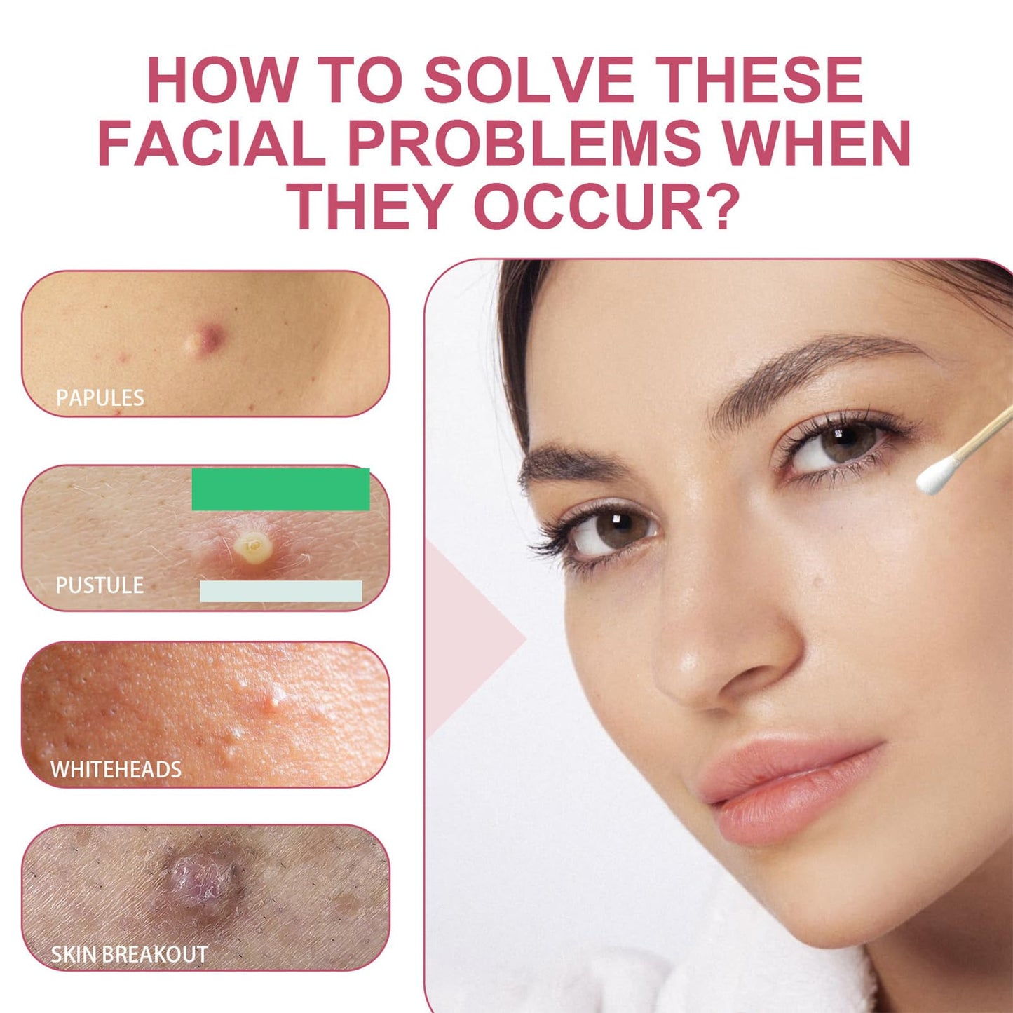 Overnight Drying Lotion, Spot Treatment for Acne, Anti-Blemish Drying Lotion For Blemishes 30ml Anti Acne Treatment Face Serum for Facial Pimples/Zits, Acne Control, Reduce Redness