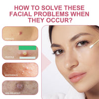 Overnight Drying Lotion, Spot Treatment for Acne, Anti-Blemish Drying Lotion For Blemishes 30ml Anti Acne Treatment Face Serum for Facial Pimples/Zits, Acne Control, Reduce Redness