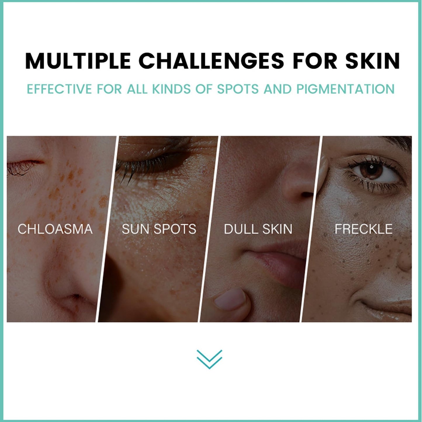 MEITREND Melasma Treatment For Face,Dark Spot Remover for Face & Body, Pigmentation Removal Cream,Corrector For Age Spots Sun Spots Freckles Melasma Brown Spots,Freckle Removal Cream