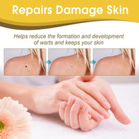 ponizno Wart Remover, Skin TagRemovel for Hands and Body Easy to Use Natural & Safe Remover