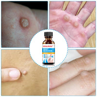 Enigmapn Wart-Remover Painless Skin and Fast-Acting, Wart-Remover for Hands and Body Fall Away Quickly, Natural Remover-15ml