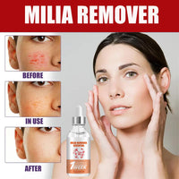 MrCuvaryas Milia Remover, Milia Spot Serum for Face, Milia Spot Removal Helps to Ruduce Milia, Dark Circles Under Eye for Women & Men, Anti Aging Anti Wrinkle, Reduces Bags, Saggy Skin & Puffy Eyes (1PCS)