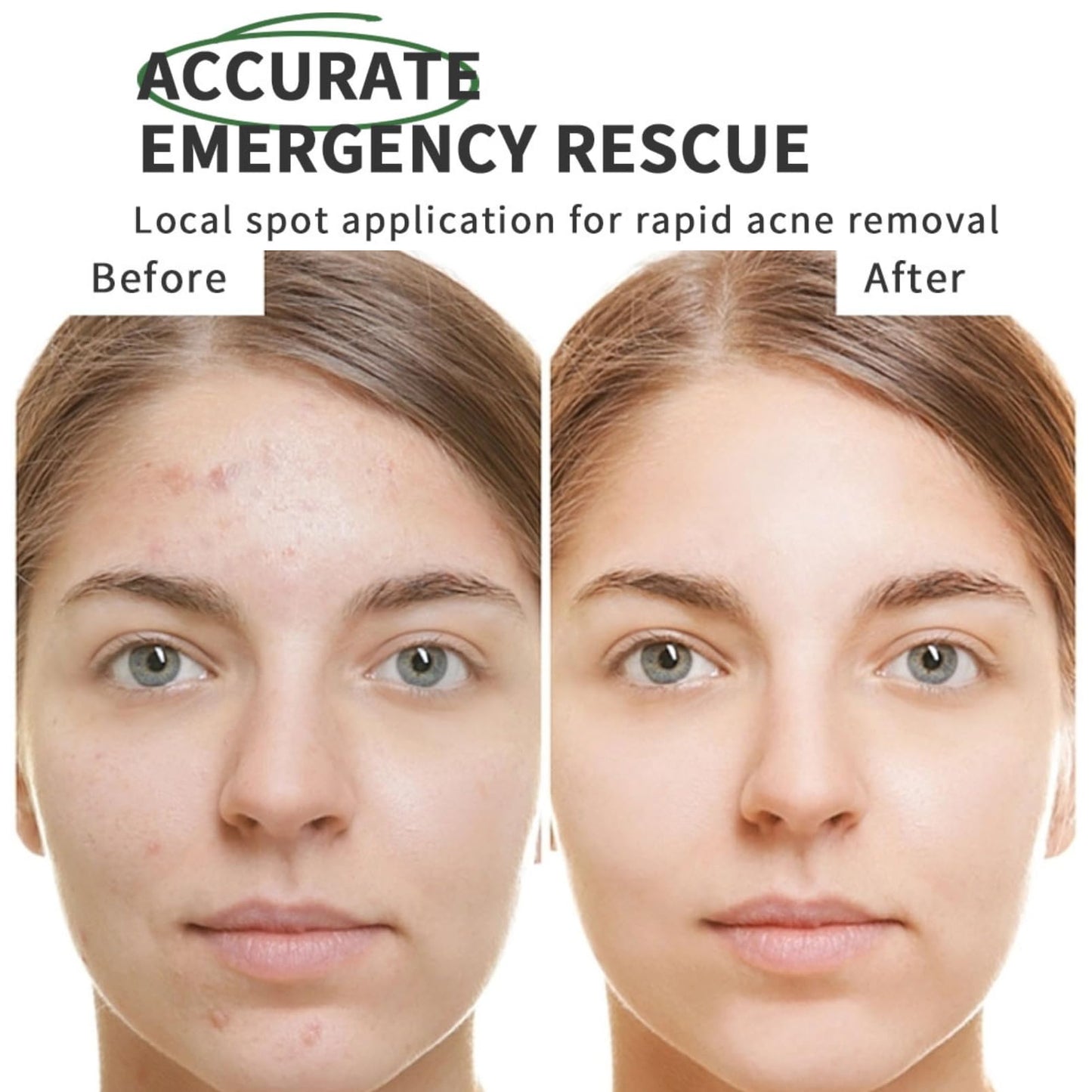 Cureluxe Anti Acne Serum - Acne Drying Lotion – Fast-Acting Blemish & Spot Treatment - Face Serum to Reduce Redness & Pimples - Dry Out Pimples,Clean Pores - Teen Girls, Women & Men Skin Care