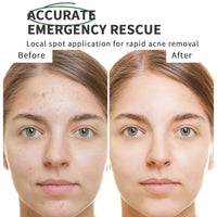 Cureluxe Anti Acne Serum - Acne Drying Lotion – Fast-Acting Blemish & Spot Treatment - Face Serum to Reduce Redness & Pimples - Dry Out Pimples,Clean Pores - Teen Girls, Women & Men Skin Care