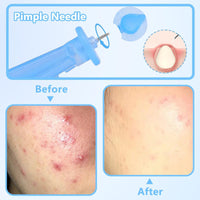 BPTZYLN 200 Pcs Pimple Needle Blackhead Blemish Remover, Milia Removal Needle Blue Tool Cyst Removal, Professional Pimple Popper Remover Tools for Clear Skin, Beauty Salon Home Sterile Needles for Cysts