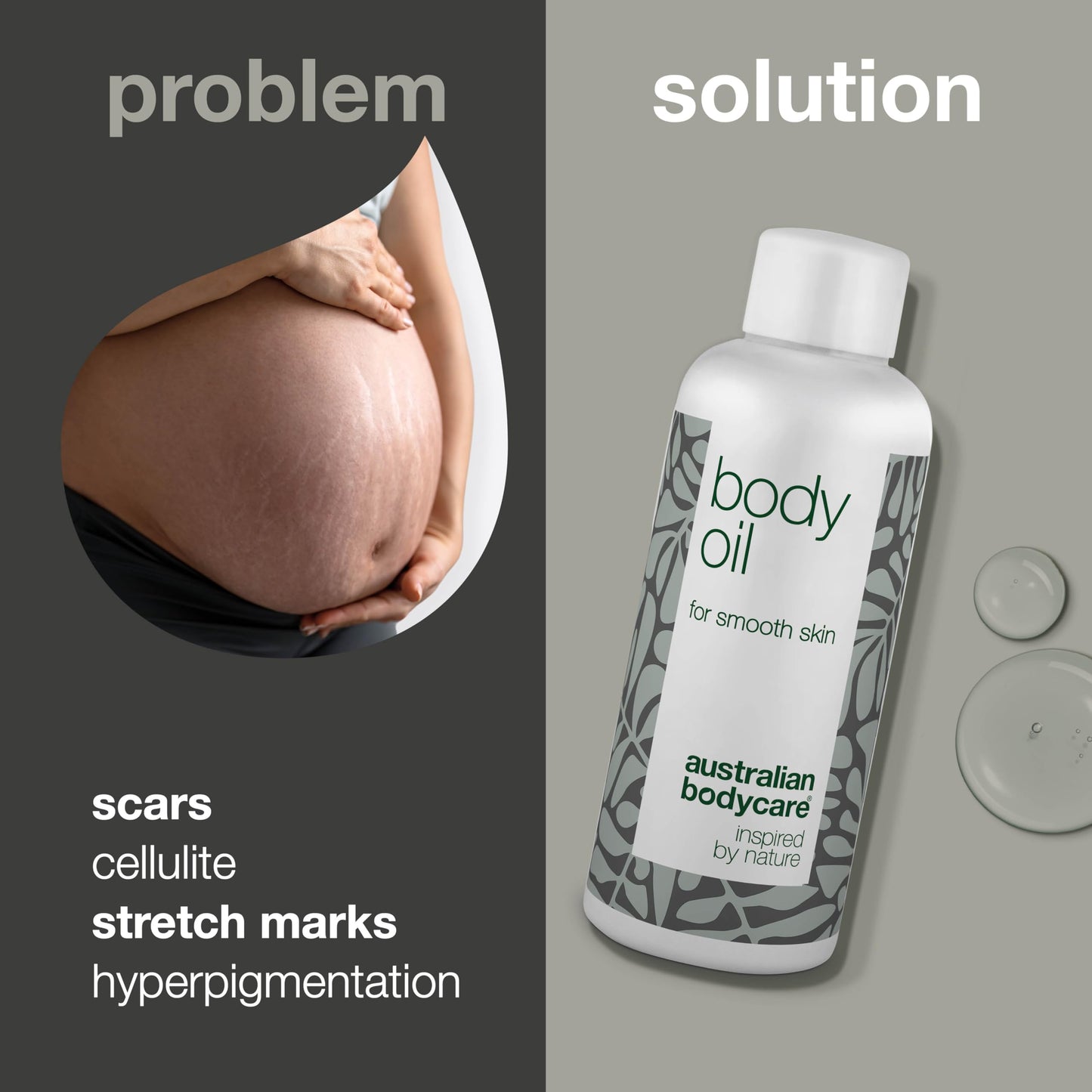 Australian Bodycare Body Oil - Improve the appearance of stretch marks, scars, orange peel skin (cellulite), pigment spots and Uneven Skin Tone? Try Body Oil with Tea Tree Oil for whole body – 80 ml