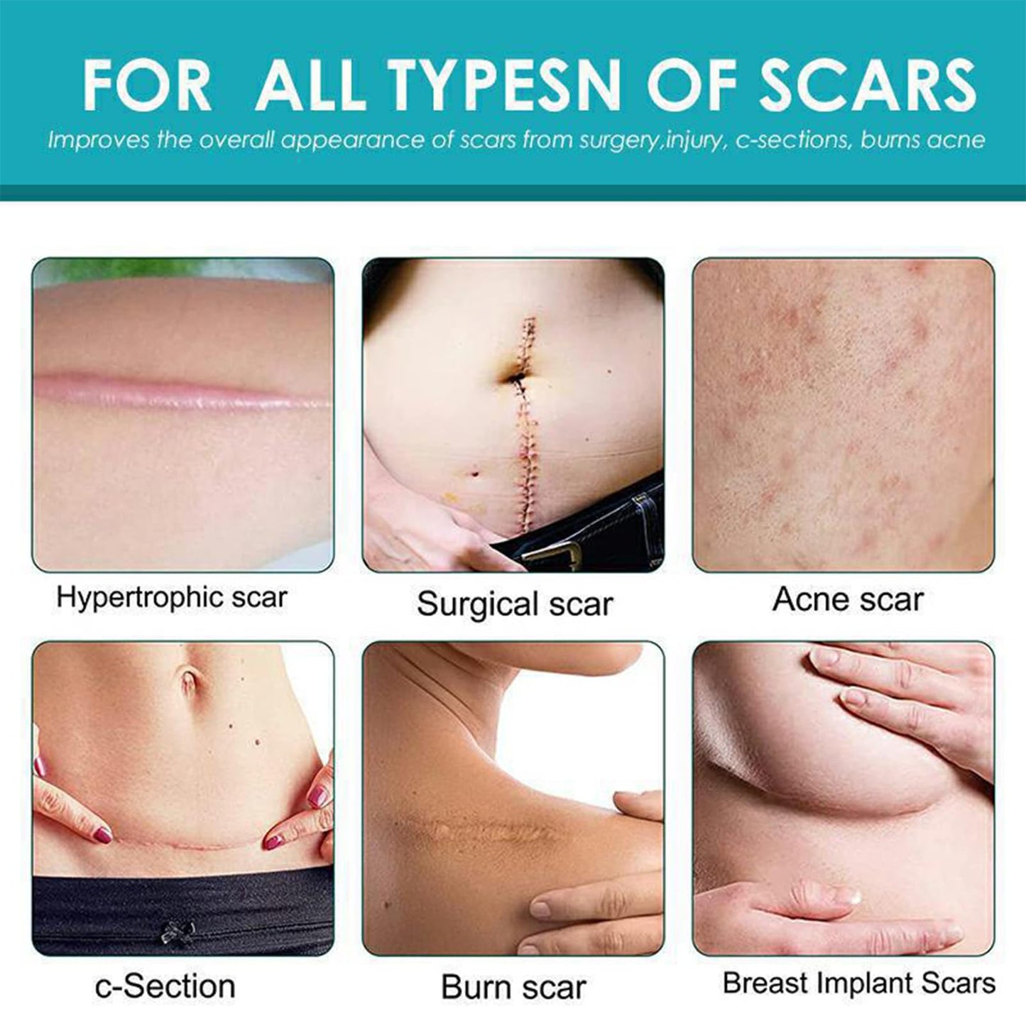 Scar Cream, Scar Removal Cream, Stretch Mark Removal Cream, Scar Erase, Skin Repair Cream for Face & Body Scar, for C-Section, Burns, Stretch Marks, Acne, Surgery, Effective for Both Old and New Scars