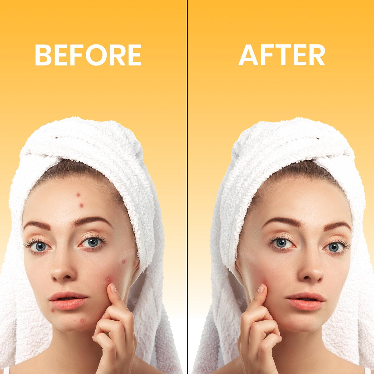 nuvora Nuvora Acne Patches 72 Count – Hydrocolloid Pimple Patches for Face & Body – Ultra-Thin, Invisible Spot Treatment Stickers – Fast Healing, Vegan & Cruelty-Free Skincare