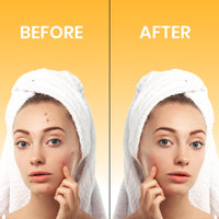 nuvora Nuvora Acne Patches 72 Count – Hydrocolloid Pimple Patches for Face & Body – Ultra-Thin, Invisible Spot Treatment Stickers – Fast Healing, Vegan & Cruelty-Free Skincare