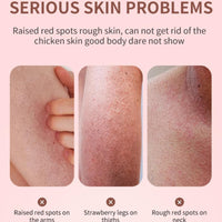 jinyue S-trawberry S-kin Treatment,Strawberry Legs Treatment,Keratosis Pilaris Cream，Keratinization & Exfoliating Body Cream for Bumpy Skin, Chicken Skin & Strawberry Spots Repair120g