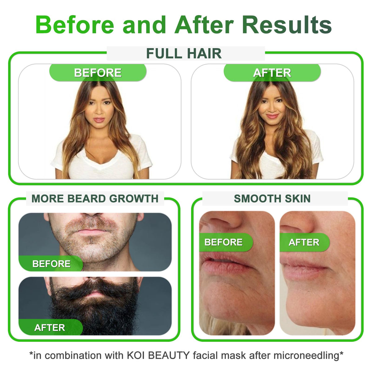 Koi Beauty KOI BEAUTY Adjustable Derma Stamp- 140 REAL NEEDLE, Professional Microneedling 0-3mm Home, Dermastamp for Face Hair Scalp Beard Growth Body, Derma Roller & Microneedling Pen Alternative for Men Women