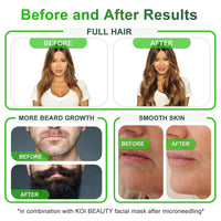 Koi Beauty KOI BEAUTY Adjustable Derma Stamp- 140 REAL NEEDLE, Professional Microneedling 0-3mm Home, Dermastamp for Face Hair Scalp Beard Growth Body, Derma Roller & Microneedling Pen Alternative for Men Women