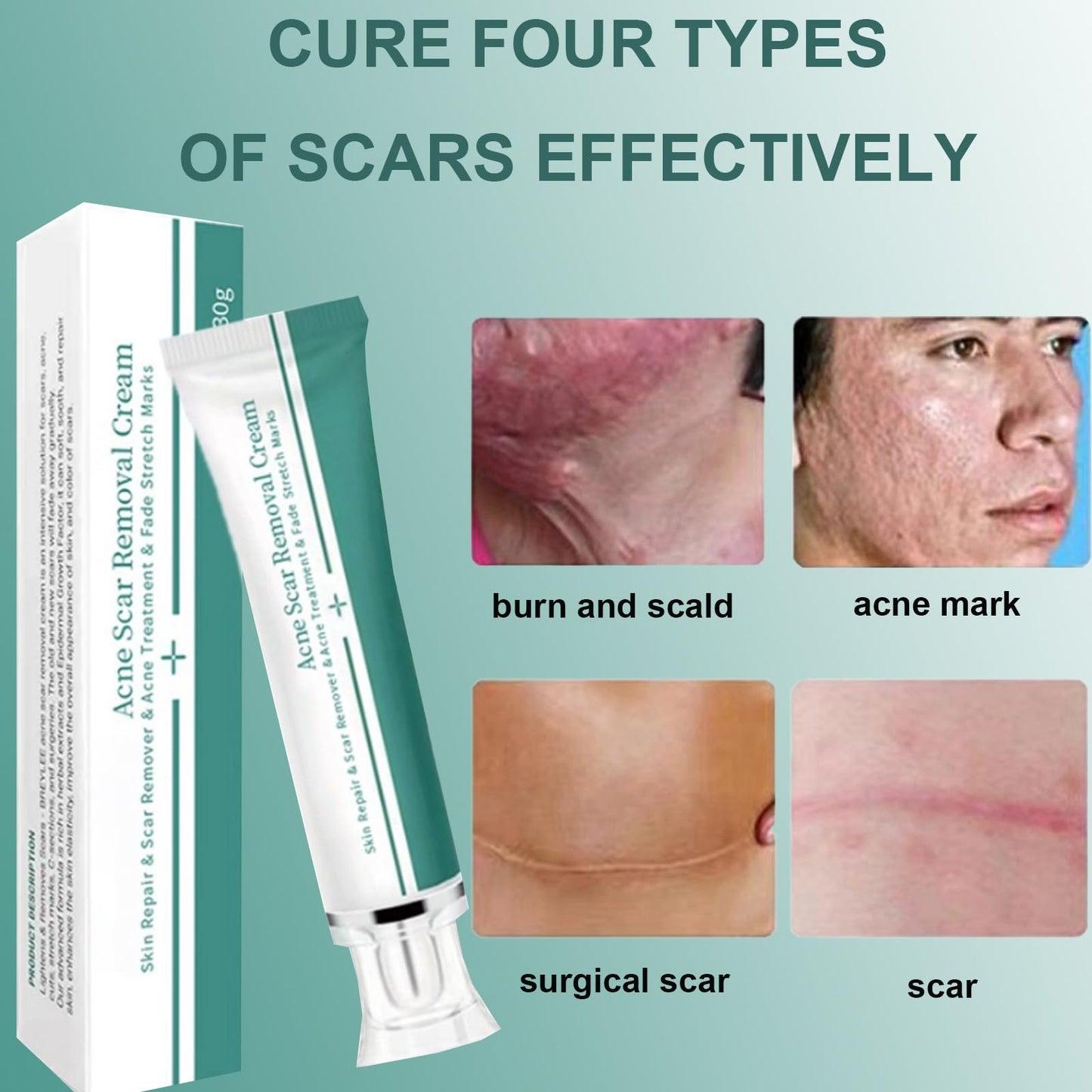 Shengqialun Herbal Scar Cream, Advanced Scar Treatment, Scar Healing Cream for Skin Repair, Scar Remover, Acne Treatment, Fade Stretch Marks, Scar Removal Cream Effective On Old & New Scars Face& Body