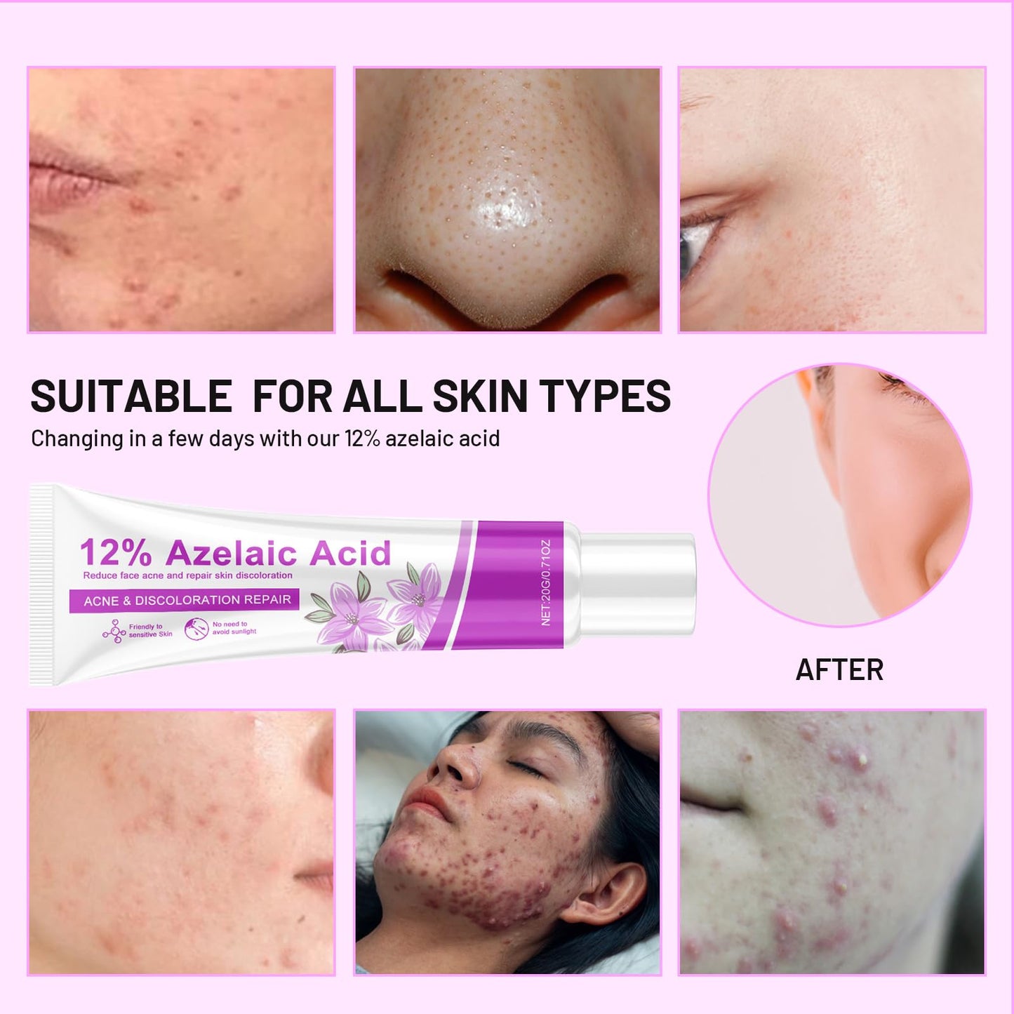 Bettinay Rosacea Cream for Face, 12% Azelaic Acid Cream, Gentle and Moisturizing for all Skin Pigmentation Redness