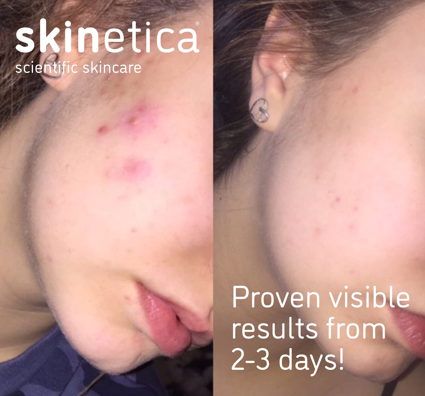 Skinetica Quintessence Face Toner for Acne, Spots and Blemishes 100ml | No Harsh Chemical, Paraben-Free & Vegan Friendly Toner for Face | Refreshing & Non-Irritating Skin Toner for Sensitive Skin