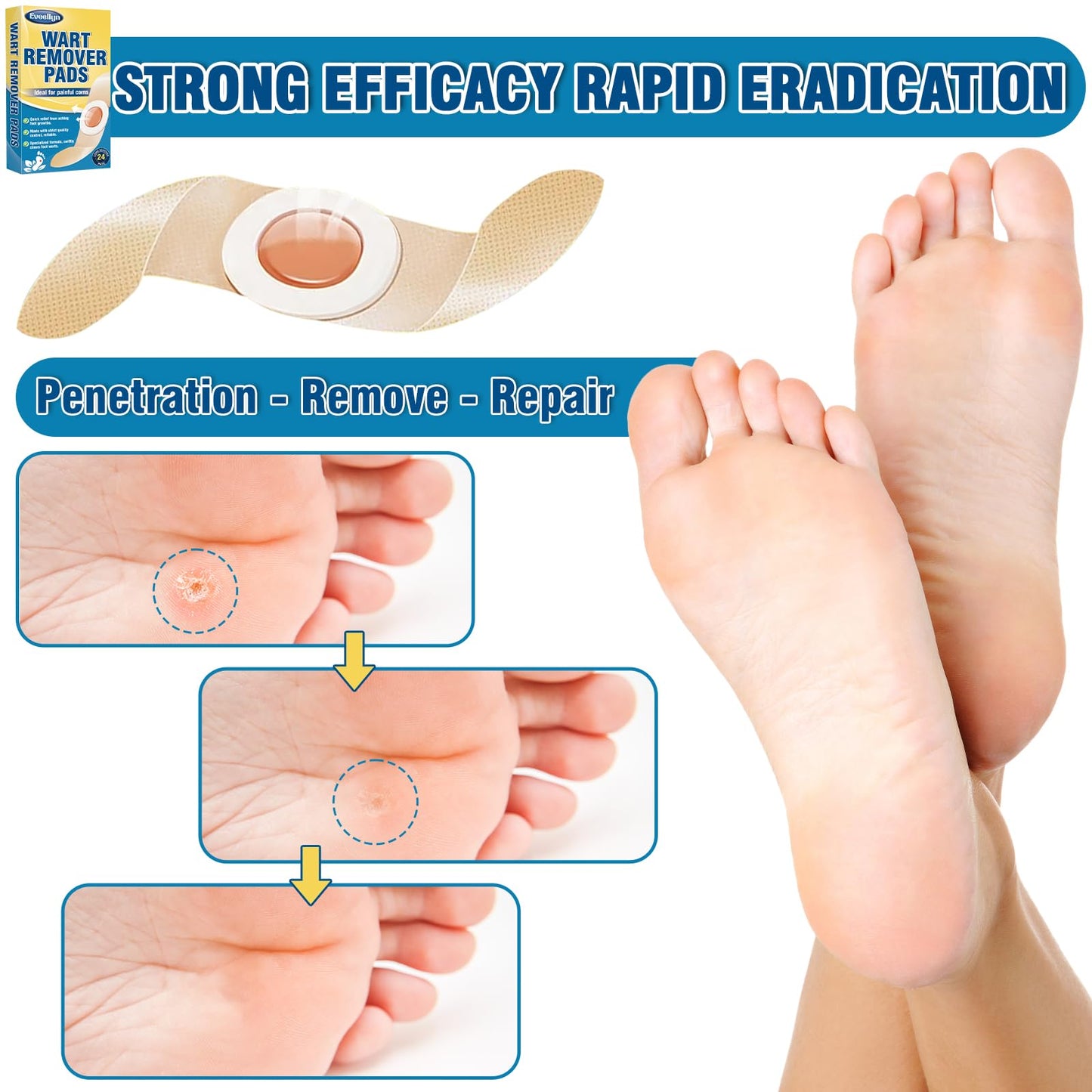 Eveellyn Wart Removal