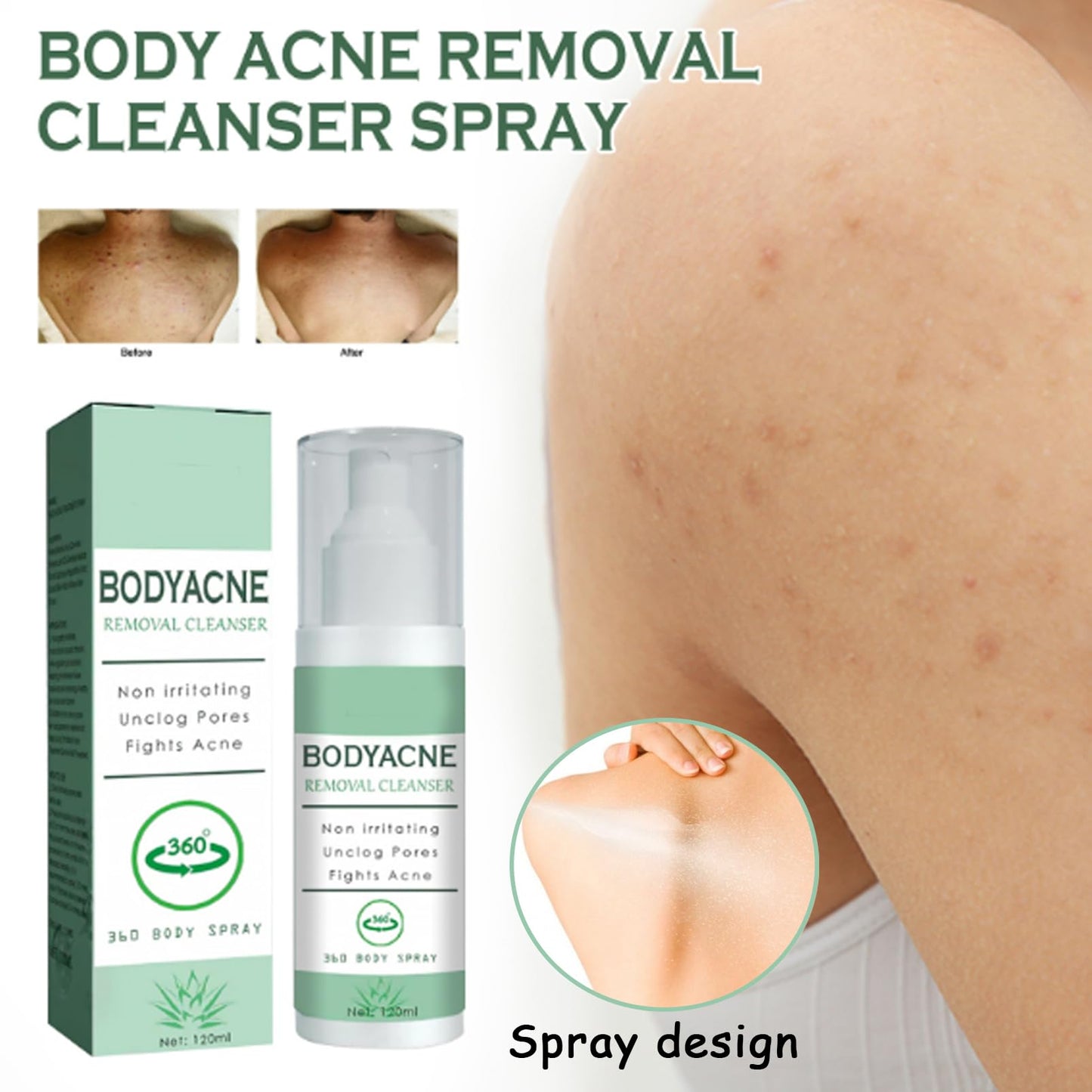 DMQ Acne Treatment Spary,Back Acne Treatment Serum,Body Moisturiser For Acne,Body Moisturiser For Dry Skin,Acne Moisturiser,Reduce Back Acne & Body Acne,Smoothing Moisturiser For Acne Prone Skin-120ml