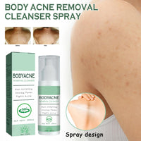 DMQ Acne Treatment Spary,Back Acne Treatment Serum,Body Moisturiser For Acne,Body Moisturiser For Dry Skin,Acne Moisturiser,Reduce Back Acne & Body Acne,Smoothing Moisturiser For Acne Prone Skin-120ml