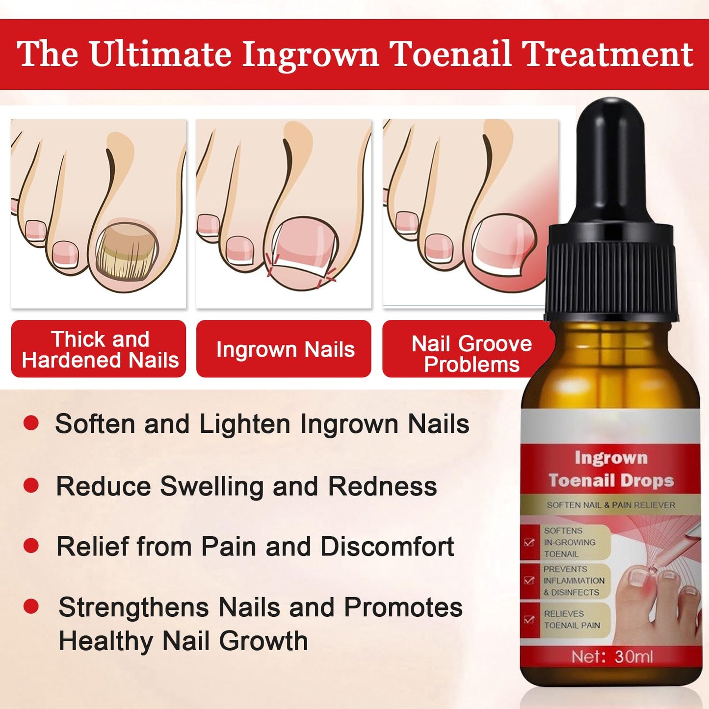 Ingrown Toenail Treatment Drop, Cuticle Care Oils for Ingrown Toenails, Trimming Toenail Softening Drops, Natural Ingrown Toenail Correction, Fungal Nail Treatment, Nail Growth Treatment, 30ml