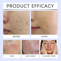 Anti Acne Face Cream,Anti A/cne Removal C/ream,Ac/ne Scar Removal Cr/eam,Dark Spot Cream,Facial Acn/e Treatment Gel,Daily Facial Moisturizer for A/cne Prone Skin,Acne Spot Treatment,Gentle Acne Cream