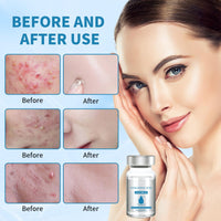 Ninnyi 6 PCS Micro Infusion System for Lips, Beauty Micro Infusion Facial Kit