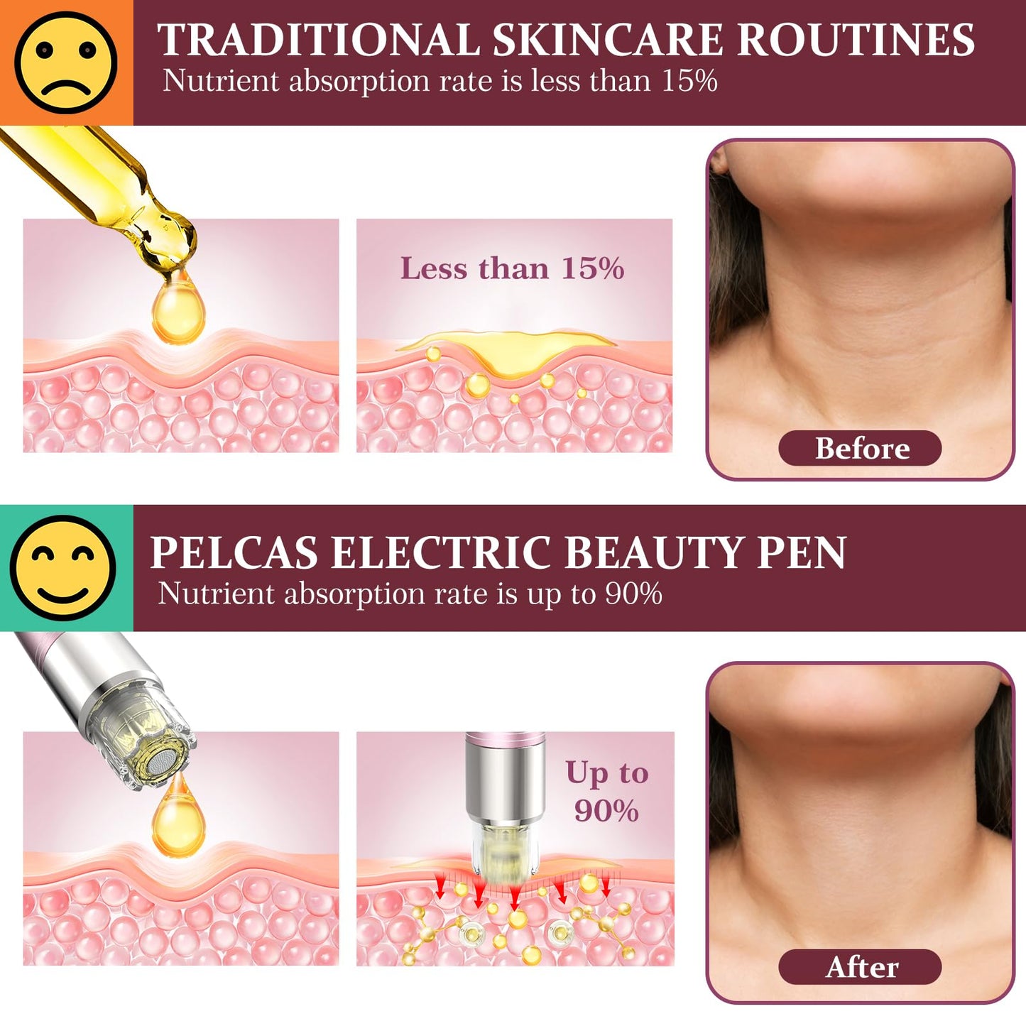 Automatic Serum Applicator Microneedling Pen PELCAS, A3 Electric Derma Pen Level 5 with LCD Screen Rechargeable Cordless Dermapen for Scars,Wrinkles,Stretch Marks,Acne,Skin Rejuvenation(Rose Gold)