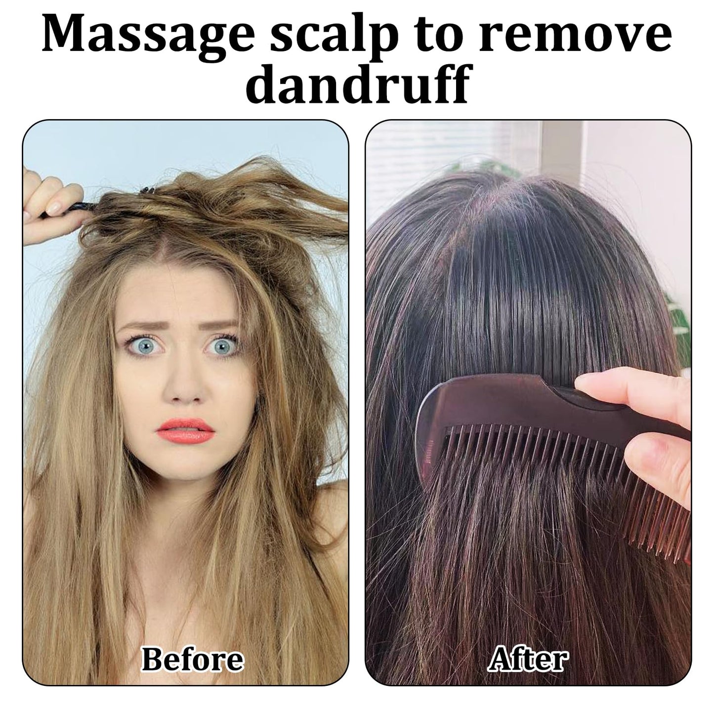 MADGININE 4 Pcs Dandruff Comb Psoriasis Comb Lice Comb Head Lice Comb Scalp Comb Multifunctional Hair Beauty Tool for Women and Men Scalp Massage Refreshing Promotes Scalp Health and Shiny Hair