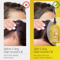 MiracleHair x2 Premium Hair Growth Oil XL 170ml - Rosemary, Biotin, Jojoba, Castor, Coffee, Almond, Argan, Baobab, Peppermint, Ginger & Tea Tree Oil - Hair Growth & Thickening & Loss Prevention - UK Based Brand