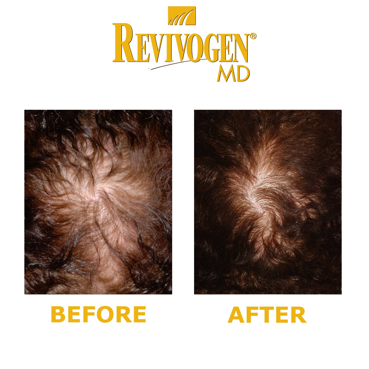 Revivogen REVIVOGEN MD Scalp Therapy. Natural Hair Loss Solution for Fine & Thinning Hair.
