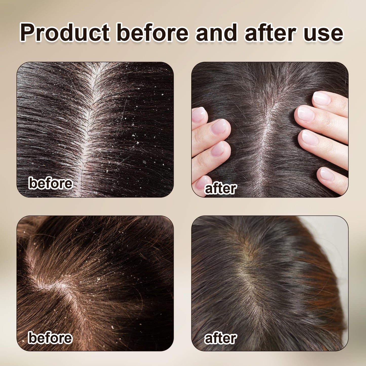 Liameph 2PCS Psoriasis Comb,Dandruff Comb,Double Sided Fine Teeth Comb,with Handle Head Lice Comb,for the Removal of Dandruff Fleas Lice Dandruff and Tangled Hair (Green,Yellow)