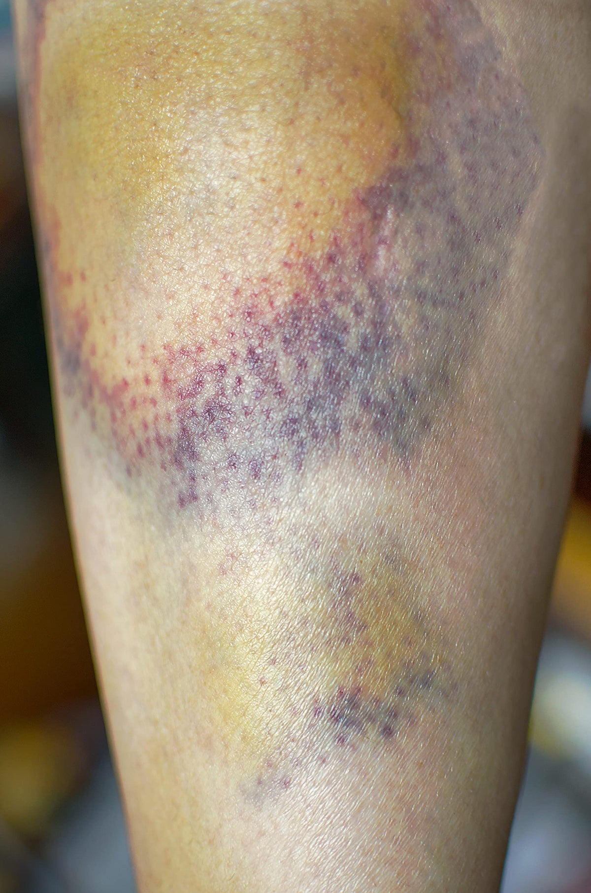 wellmadefairtrade Arnica Bruise Cream Arnica Oil for Bruising Arnica Massage Oil Arnica Massage Balm Made in Yorkshire (120ml Cream)