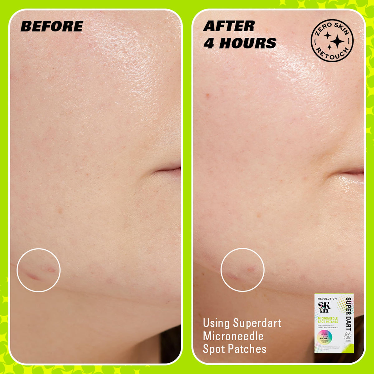 Revolution Skincare London Revolution Skin, Spot, Dot, Go! Salicylic Acid Spot Patches, Discreet Pimple Patches With Salicylic Acid & Tea Tree, Vegan & Cruelty-Free, 60 Patches Per Box