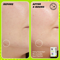 Revolution Skincare London Revolution Skin, Spot, Dot, Go! Salicylic Acid Spot Patches, Discreet Pimple Patches With Salicylic Acid & Tea Tree, Vegan & Cruelty-Free, 60 Patches Per Box