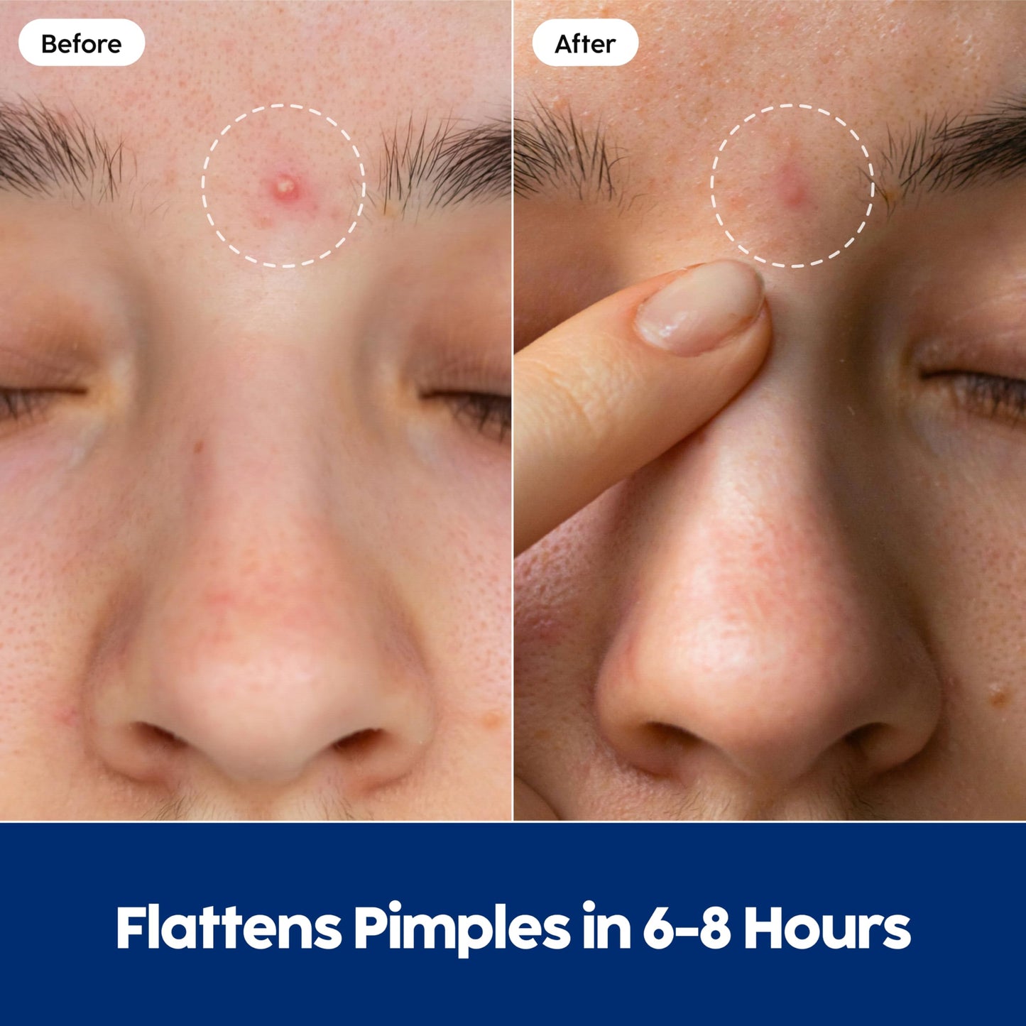Patch Perfect Spot Patches (102 Count) - Korean Hydrocolloid Pimple Patches, Absorbing Dots for Spot Treatment, Invisible Acne Patches, Vegan & Cruelty-Free Spot Stickers (2 Sizes)