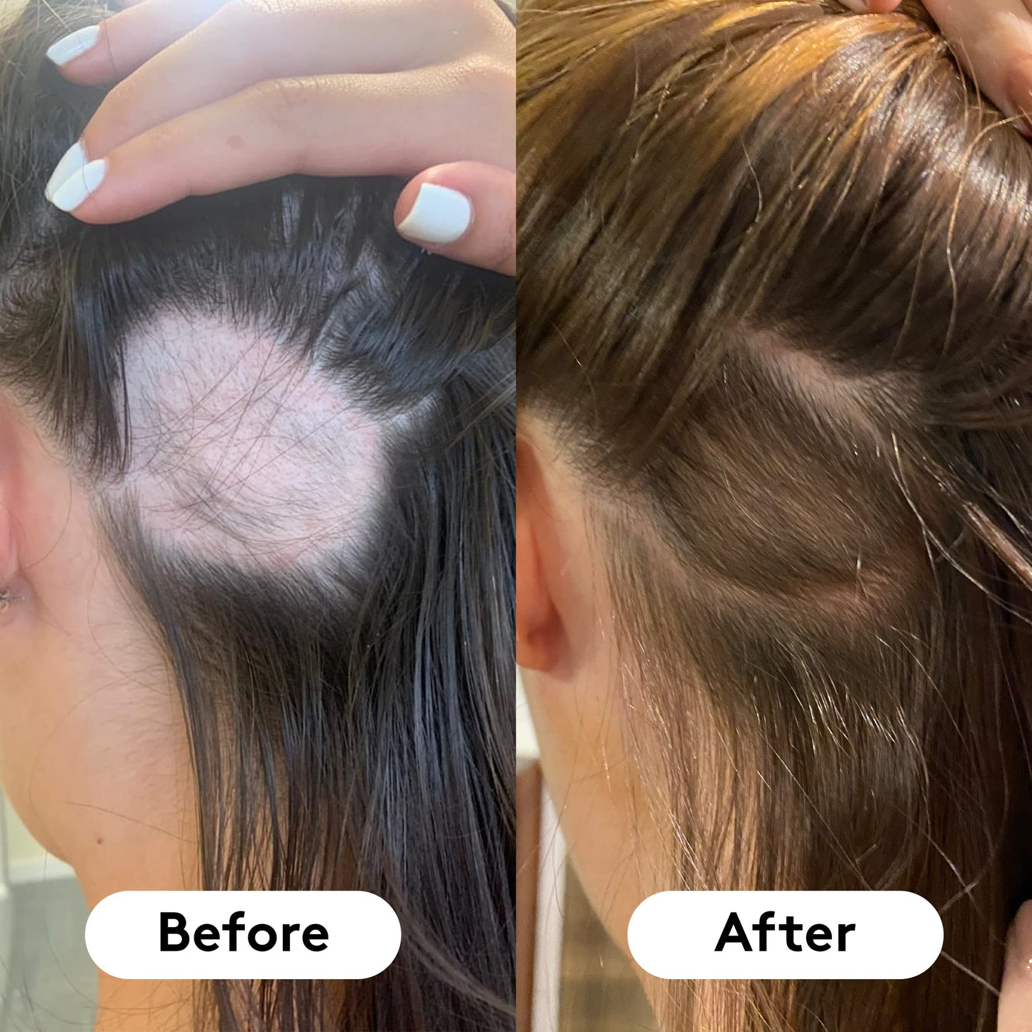 HAIR BURST Biotin Gummies for Hair Growth - Hair, Skin & Nails Vitamin Supplement, Reduces Breakage, Promotes Healthier Thicker Hair - Daily Chewable Vitamins - 1 Month